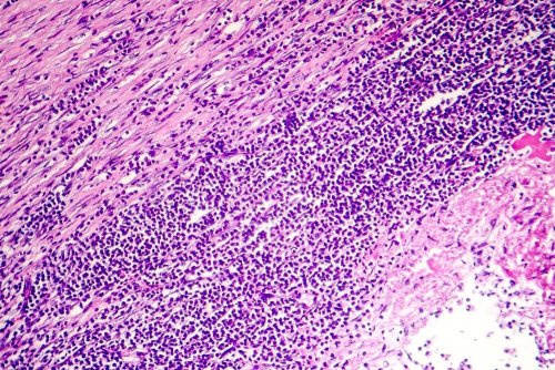 Le tissu du péricarde en cas de péricardite