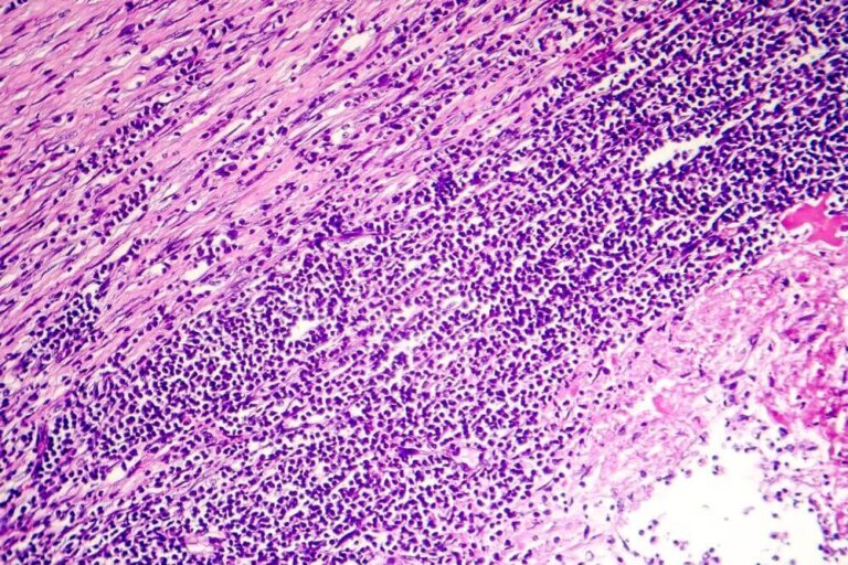 Péricardite symptômes, causes et traitement Améliore ta Santé