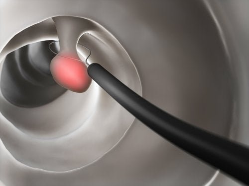 Polypes dans le côlon : les causes - Améliore ta Santé