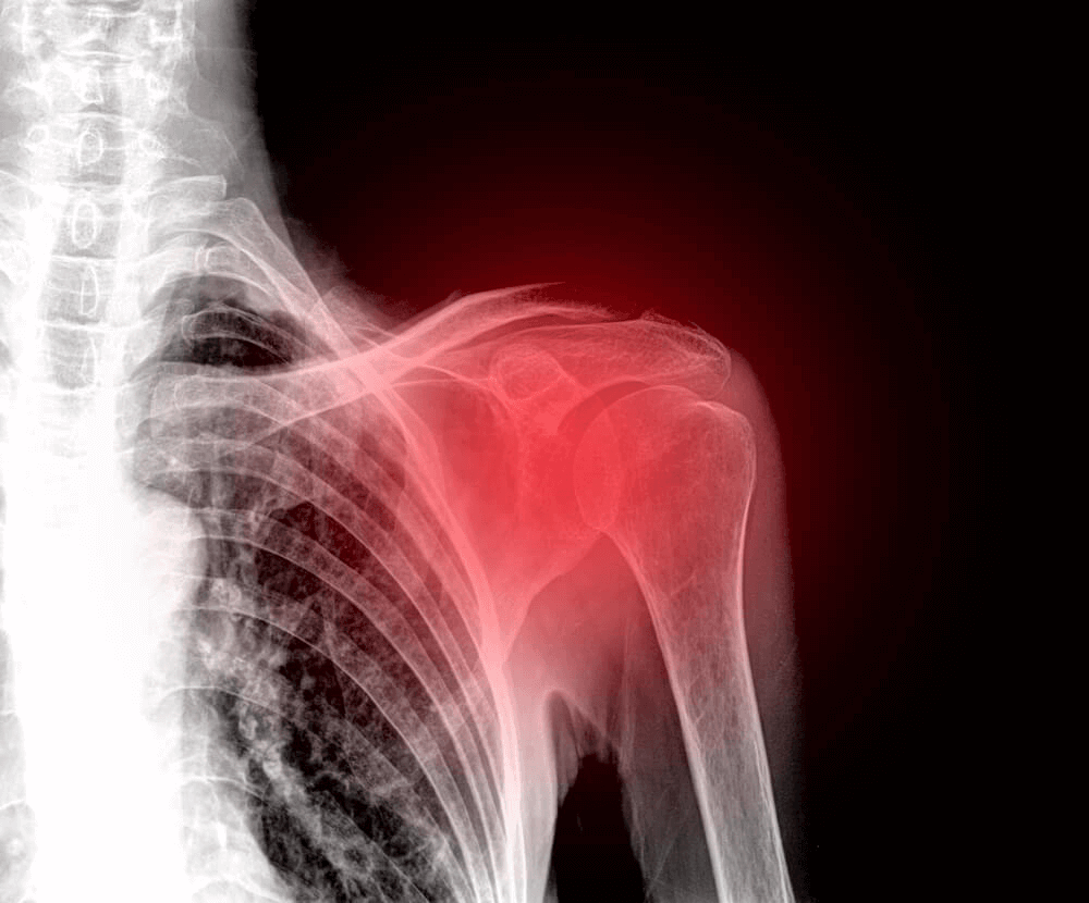 Radiographie de l'épaule localisant la rupture de la coiffe des rotateurs