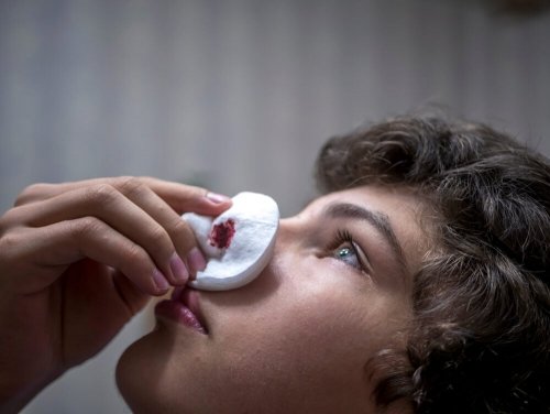 Un enfant qui saigne du nez