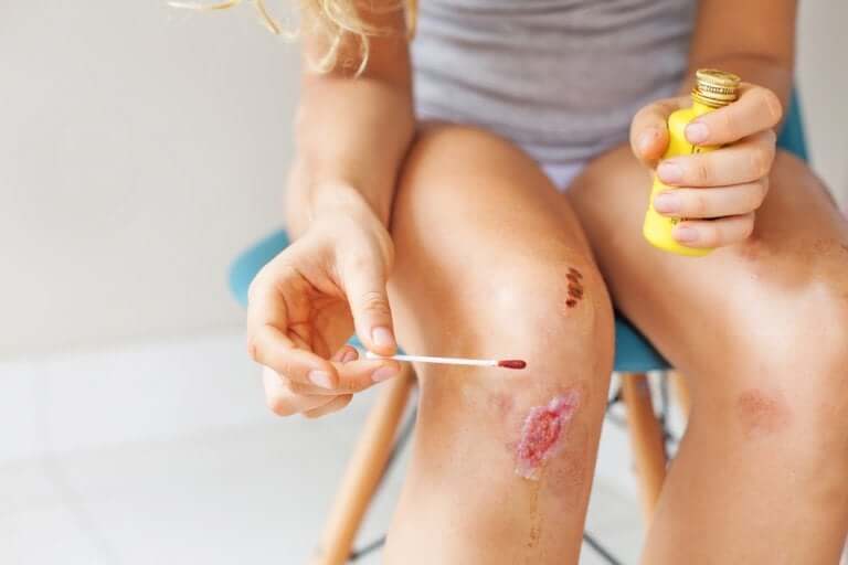 Une femme en train de traiter une plaie infectée sur son genou