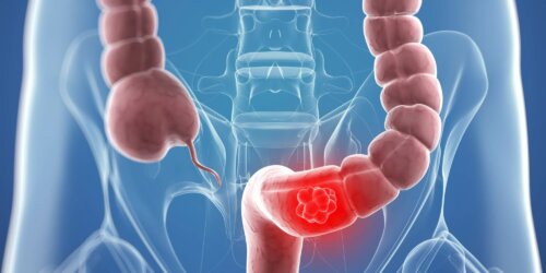 Le cancer du colon et la colostomie
