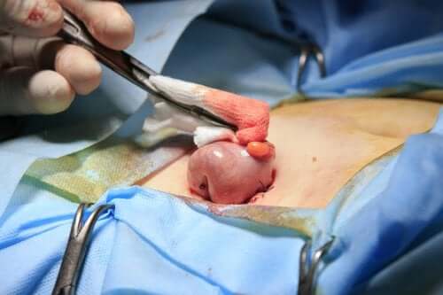 Qu'est-ce que la colostomie ?