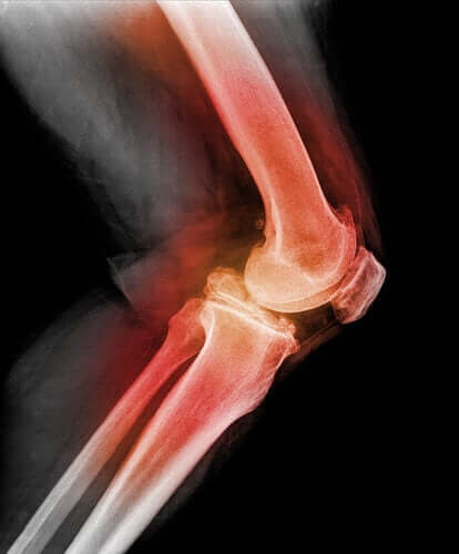 Tour ce qu'il y a à savoir sur la luxation de la rotule