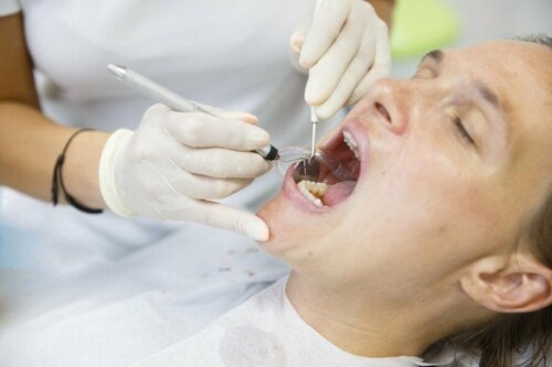 L'extraction de la dent surnuméraire en cas d'hyperdontie