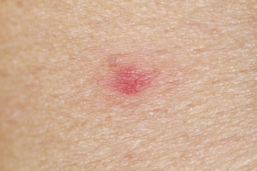 Les piqûres d'insectes peuvent parfois provoquer des allergies