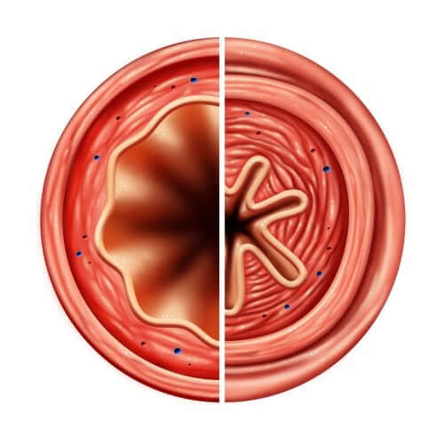 La coupe d'une trachée malade à soigner avec de la Terbutaline