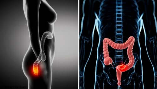 Que se passe-t-il en cas d'anuscopie ?