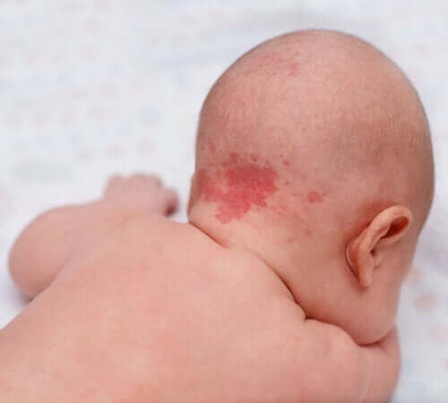 Pourquoi les taches de naissance apparaissent-elles ?