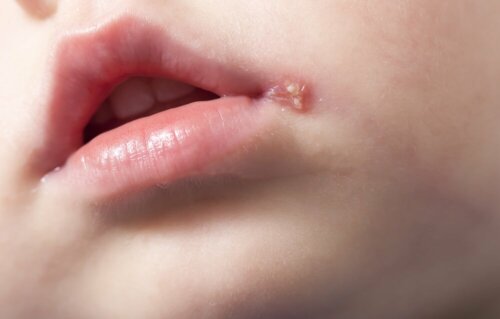 Un herpès labial chez un enfant