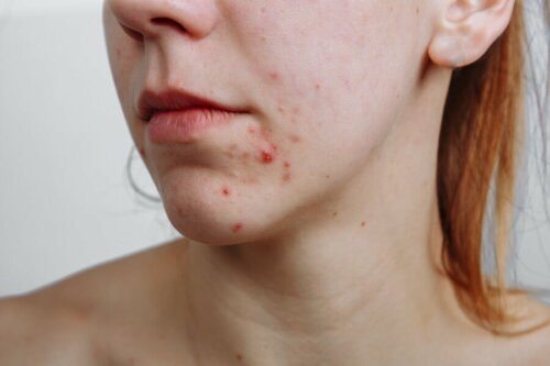 Une jeune femme ayant besoin de traitements contre l'acné