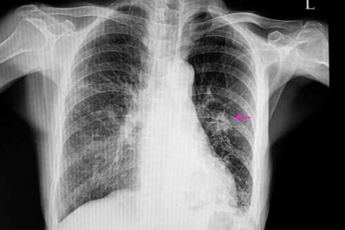 Qu'est-ce qu'un nodule pulmonaire ?