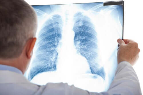La radiographie d'un poumon pour repérer un nodule pulmonaire