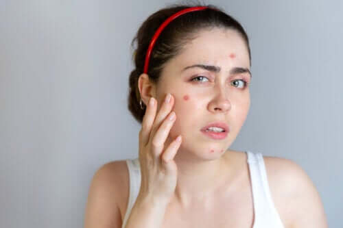 Quels traitements contre l’acné existe-t-il ?