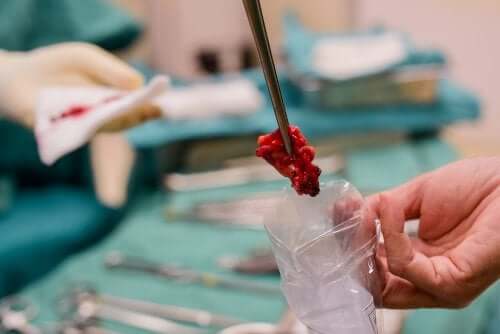 La biopsie tissulaire par opposition à la biopsie liquide