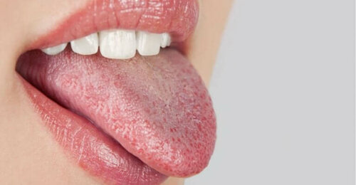 Une femme tirant la langue à cause de brûlures dans la bouche