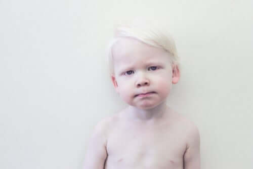 L'albinisme chez un enfant