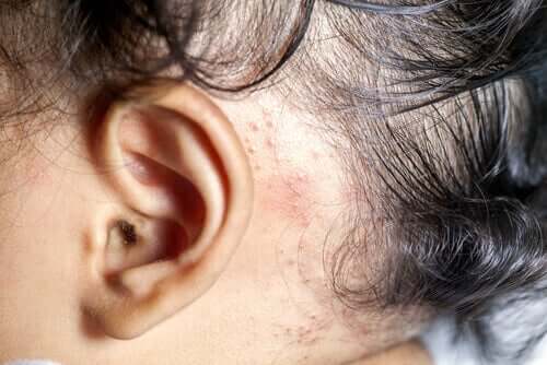 Comment traiter le psoriasis chez l'enfant ?