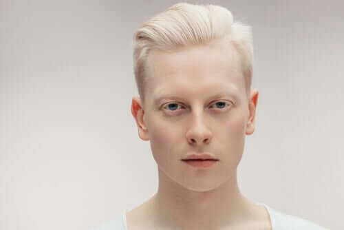 Tout ce que vous devez savoir sur l'albinisme