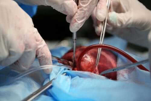 Qu’est-ce que la sternotomie ?