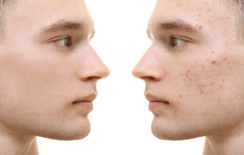 Curcuma contre l’acné : bénéfices et mode d’emploi