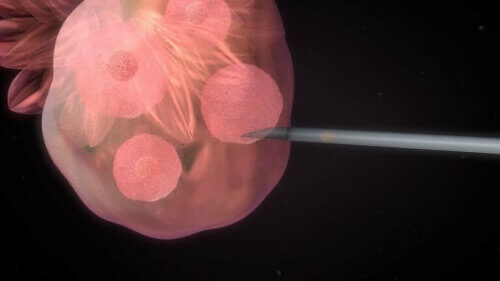 Extraction d'ovules pour une fécondation in vitro.