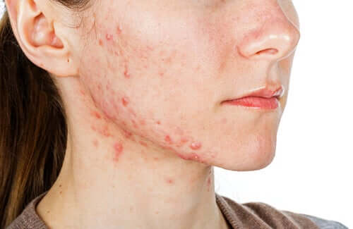 Une jeune fille souffrant d'acné nécessitant un traitement à base d'Isoface