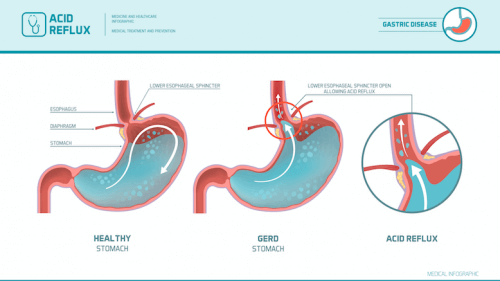 Le reflux gastro-oesophagien sous forme de schémas
