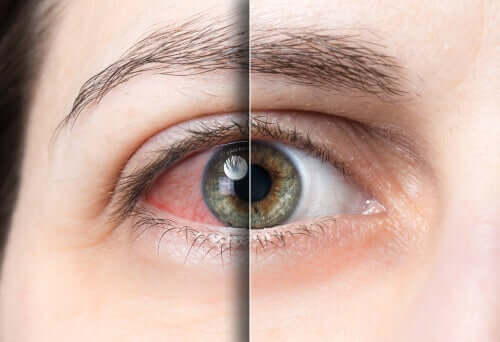 Un oeil touché par la conjonctivite et un oeil sain