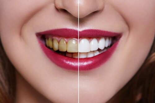 Le charbon actif ne rend pas les dents blanches