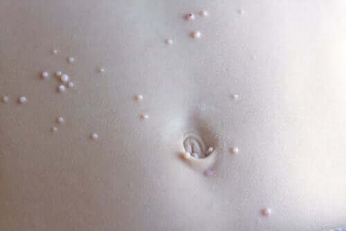 Des lésions causées par le molluscum contagiosum