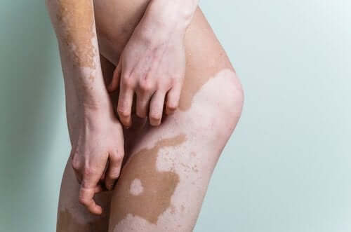 Le maquillage correcteur et le vitiligo