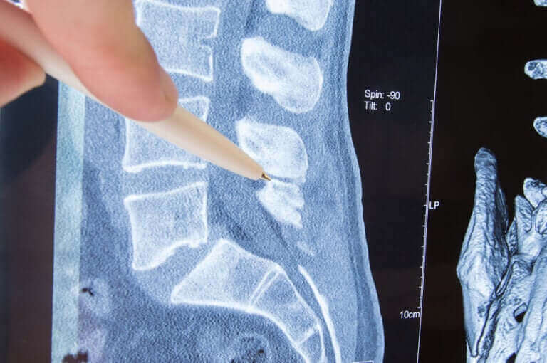 Radiculopathie : causes, symptômes et traitement