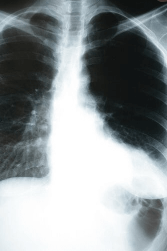 Comment la pneumonie affecte-t-elle l'organisme ?