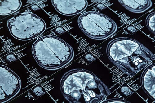 Le comportement antisocial et l'étude IRM du cerveau