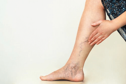 Les varices dénotent d'une mauvaise circulation des jambes