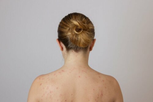 Une femme ayant des boutons de graisse dans le dos