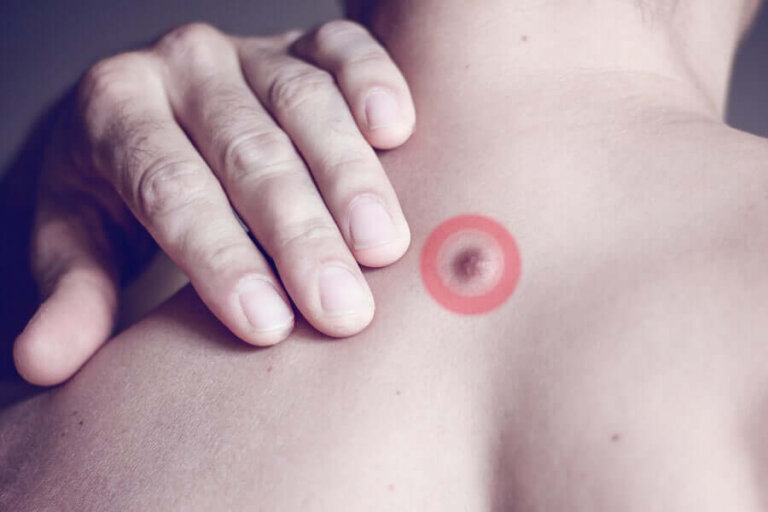 Boutons de graisse dans le dos : quelles sont les causes ?