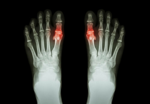 L'arthrite peut consister en l'inflammation de l'articulation des gros orteils