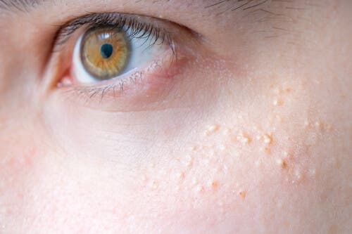 La kératose pilaire peut se présenter en haut des joues