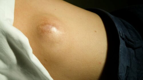 Le lipome géant fait partie des boules de graisse pouvant apparaître dans le dos