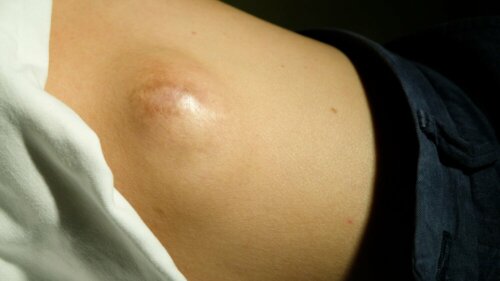 Lipome malin.