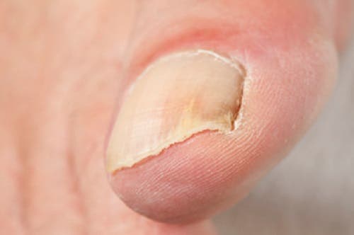 L'onychomycose consiste en l'infection d'un ongle