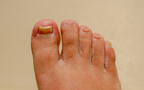 L'onychomycose : les remèdes naturels populaires fonctionnent-ils ?