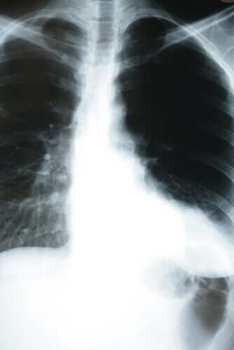 La pneumonie silencieuse observée sur une radio