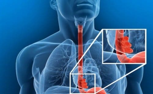 Une personne ayant une corps étranger oesophagien