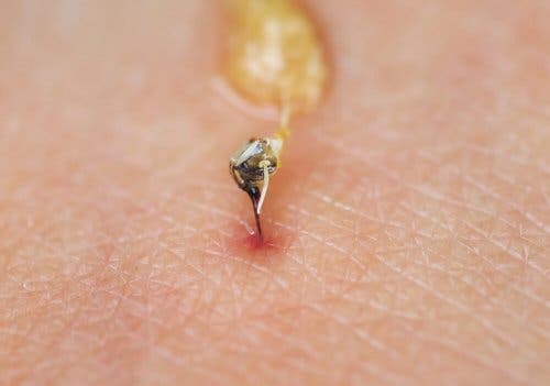 Après une piqûre d'abeille, retirer le dard enfoncé dans peau