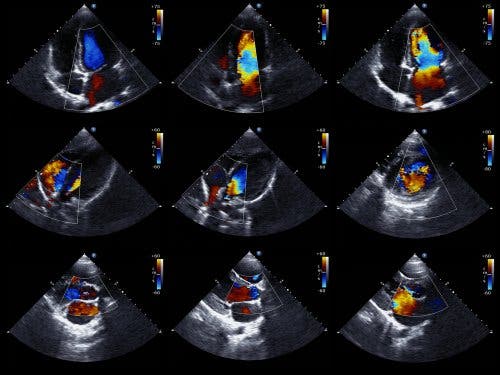 L’échocardiogramme pour détecter l’épanchement péricardique
