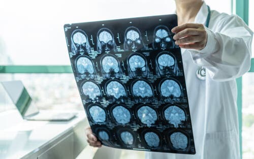 Une IRM du cerveau pour repérer une encéphalite
